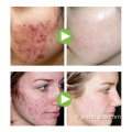 Réparation d&#39;acné Réparation Aloe Vera Gel Soins de la peau